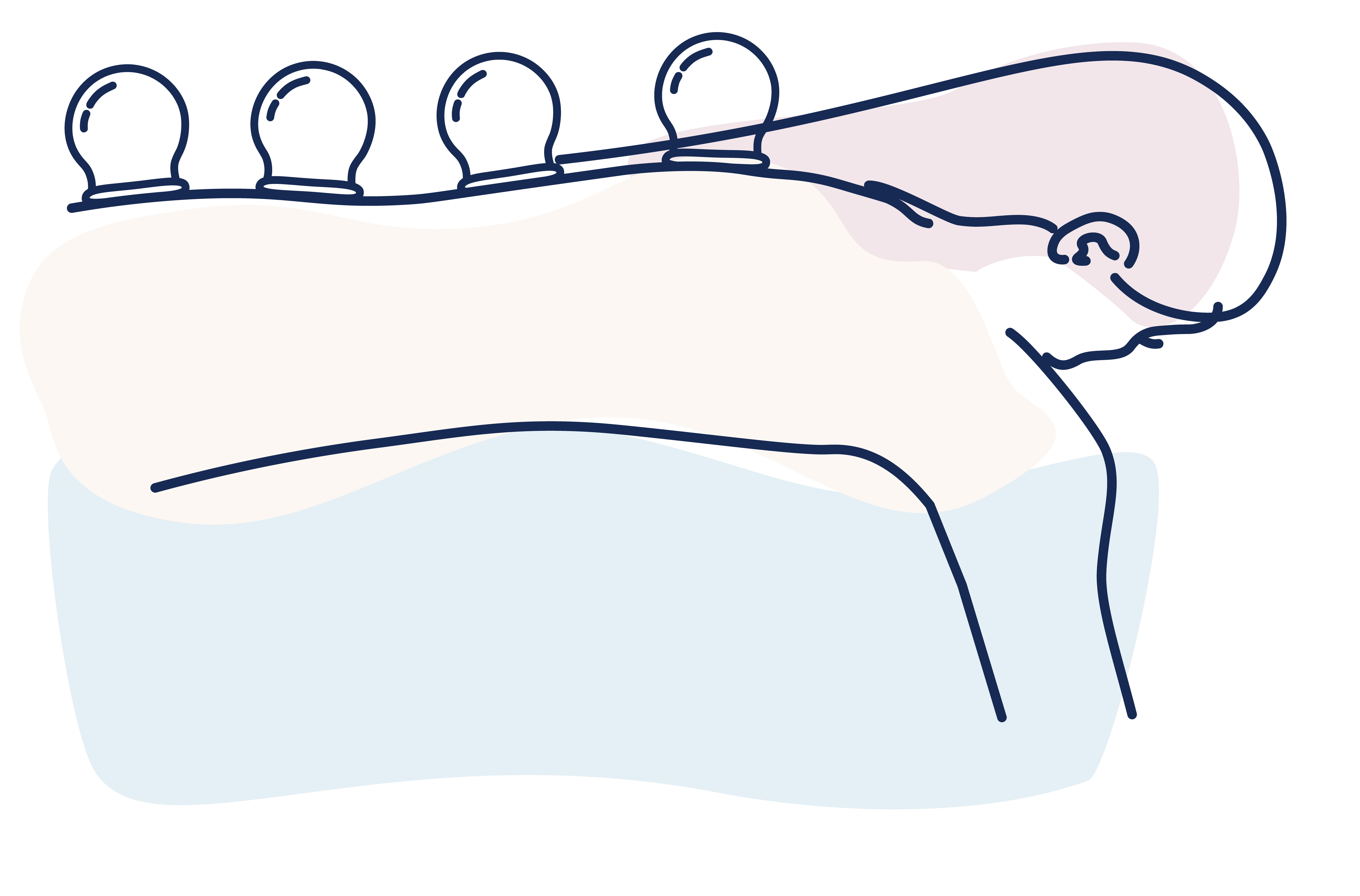 illustration of cupping massage