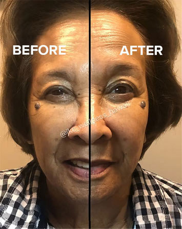 JKC Wellness's Facial Cupping Therapy