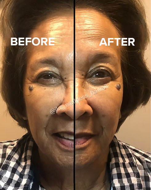 JKC Wellness's Facial Cupping Therapy