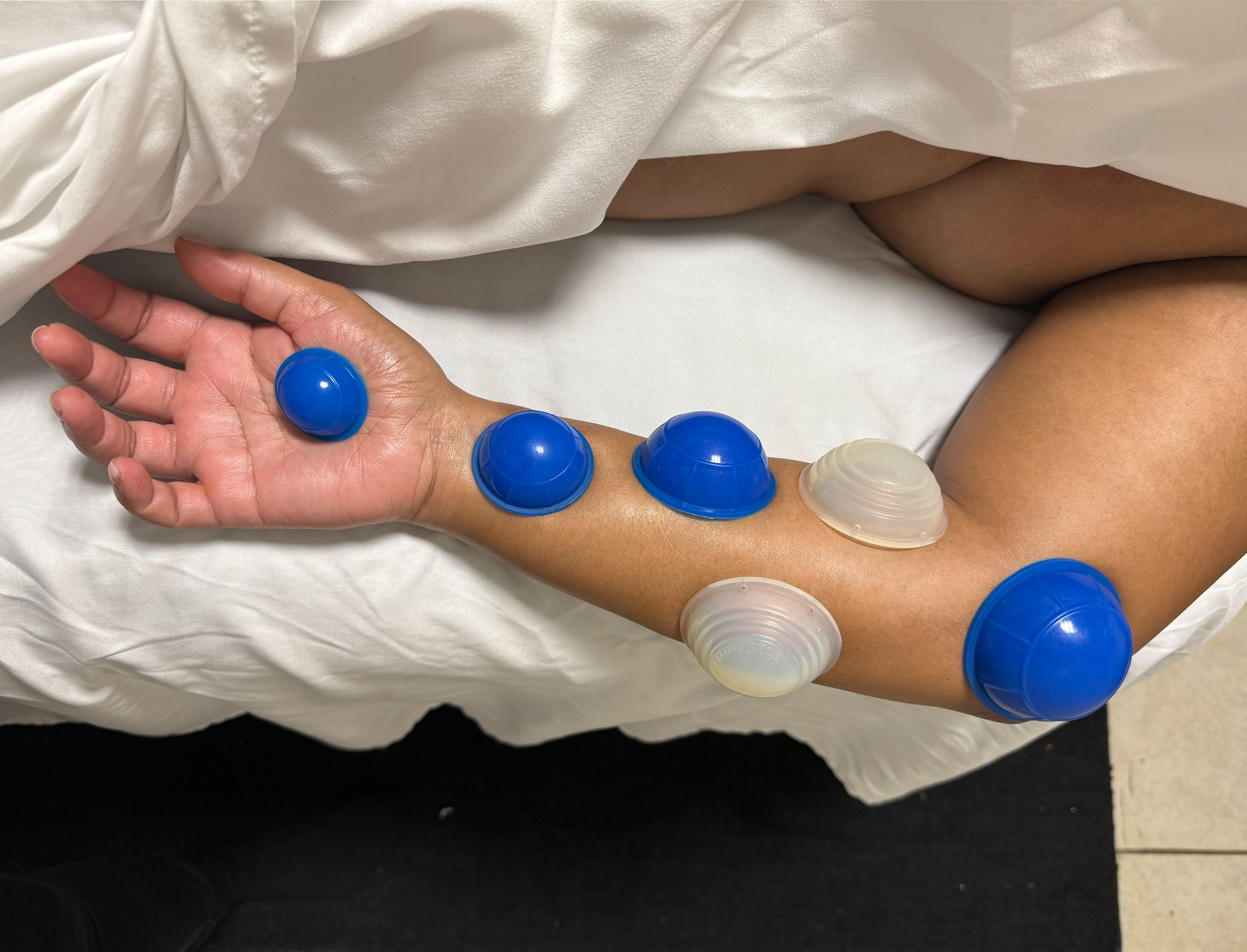 JKC Wellness arm cupping therapy